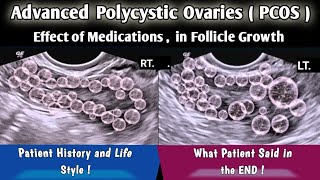 Ultrasound Polycystic Ovaries PCOS  Follicle Development after Medications [upl. by Ravi]