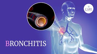 Know About Bronchitis Types Causes Symptoms Treatment And Prevention  CARE Hospitals [upl. by Ydnys263]