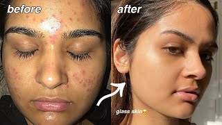 how i cleared my acne FOR GOOD something finally worked [upl. by Wiles983]