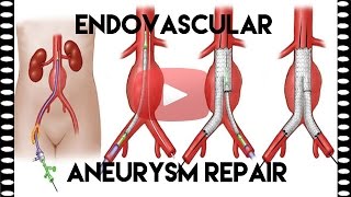 What is EVAR or Endovascular Aneurysm Repair  Medical Coding Tips [upl. by Callie]