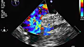 Interatrial Septal Aneurysm and Patent Foramen Ovale  Echocardiography [upl. by Kimberlee]