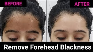 Get rid of Black Forehead  Whiten amp Brighten your Skin Naturally [upl. by Tedder]