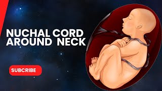 Nuchal cord Around baby neck diagnosis on ultrasound [upl. by Oinotnaocram]