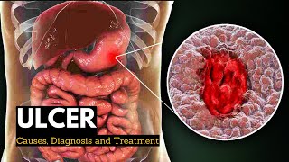 Ulcer Causes Signs and Symptoms Diagnosis and Treatment [upl. by Sanferd639]