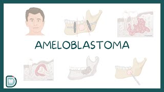 Understanding Ameloblastoma Causes Diagnosis Types and Treatment [upl. by Gierk]