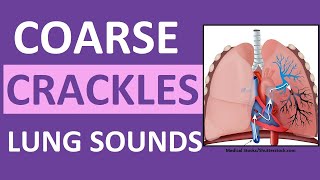 Crackles Coarse Lung Sounds  Crackles and Rales Breath Sounds Abnormal [upl. by Bruce703]