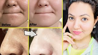 कितने भी मुश्किल Blackheads Whiteheads कील सफेद दाने हों follow करें ये 5 steps और पाएँ चमकदार skin [upl. by Dunton]