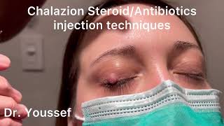 Chalazion Easiest and simplest Treatment with Steroid and Antibiotic Injections [upl. by Nylirac]