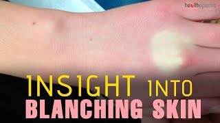 Blanching Skin  Causes Symptoms and Treatment [upl. by Ittocs]