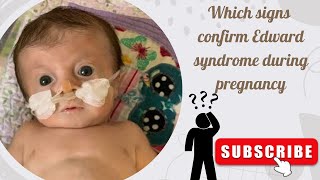 Edward syndrome  trisomy 18 signs on ultrasound Part 1 [upl. by Araihc492]