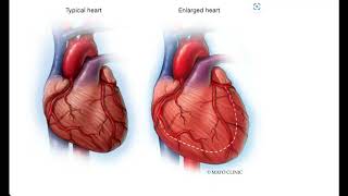 Cardiomegaly Video Lecture [upl. by Ozen]