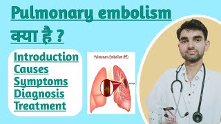 Pulmonary embolism in Hindi  Causes  Sign and Symptoms  Treatment of Pulmonary Embolism [upl. by Aisor]