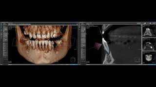 Rayscan alpha plus OnDemand 3D Evaluation of periapical pathosis [upl. by Eiralam398]