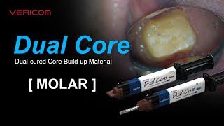 Dual Cured Core Build up Material Molar [upl. by Drarej]