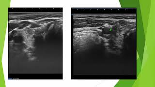 Nodule TIRADS 5 en échographie [upl. by Ahseuqal]
