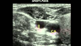 Video procedurale Guida con ecografia per laccesso venoso centrale parte 2 [upl. by Llewoh165]