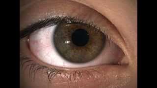 Hippus pupil fluctuation in a normal healthy eye [upl. by Tannen]