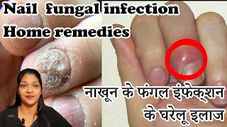 Paronychia treatment home remedies in hindi How to cure Nail fungus  Onychomycosis [upl. by Jeremy]