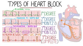 Heart Blocks Made Easy  1st 2nd Mobitz 1Wenckebach amp Mobitz 2 3rd Complete  with ECGs [upl. by Stark]