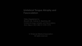 Unilateral Tongue Atrophy and Fasciculation [upl. by Doowyah]