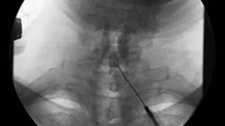 Cervical Interlaminar Epidural Steroid Injection  ThePainSourcecom [upl. by Huba82]