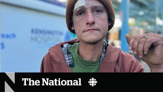 How a fleshrotting ‘zombie drug’ is complicating the overdose crisis [upl. by Babb275]