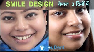 Teeth Gap Treatment in 5 Days I Zirconia Cap I Best Smile Design Dentist in INDIA youdent ​ [upl. by Kalil]