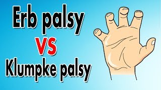 Erbs Palsy vs Klumpkes Palsy [upl. by Hobey]