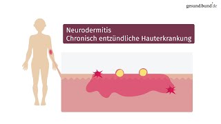 Was ist Neurodermitis und wie kann man sie behandeln [upl. by Ebeohp]