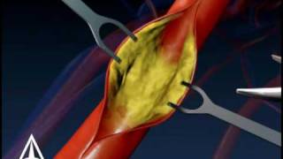 Carotid Endarectomy  3D Medical Animation [upl. by Beller]