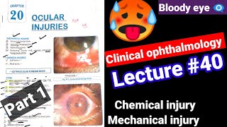 🔴Clinical ophthalmology lectures 40 ocular injuriesmechanicalchemical injury Contusion Hypema [upl. by Nbi232]