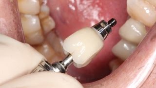 Full Contour Zirconia Implant Crown Insert [upl. by Cinderella207]