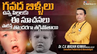 Mumps in Telugu గవద బిళ్ళలుMumps in children Dr Madan Kumar cv [upl. by Sadler108]