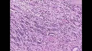 Histopathology StomachAdenocarcinoma [upl. by Etterrag]