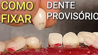 COMO FIXAR UM DENTE PROVISÓRIO  FAÇA VOCÊ MESMO [upl. by Airot]