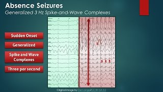 Absence Seizures EEG Findings [upl. by Tnomyar214]