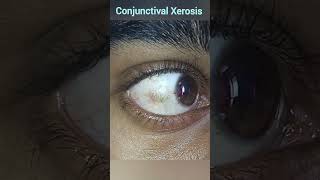 Xerophthalmia  Conjunctival Xerosis  Vitamin A Deficiencies [upl. by Joseito]