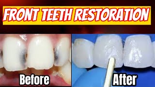 How to Fill Front Teeth Cavities with Dental Filling Procedure cavity removal dentalfilling vidiq [upl. by Hsima]