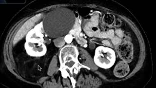 Liposarcoma [upl. by Lalita634]