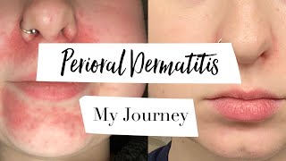 How I Treated My Perioral Dermatitis  MY JOURNEY [upl. by Notac]