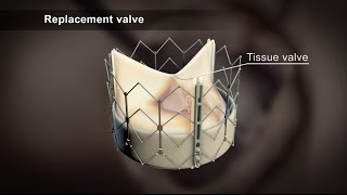 TAVI Transcatheter Aortic Valve Implantation [upl. by Annabela138]