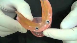 Prótese sobre implante  Overdenture [upl. by Bernard]