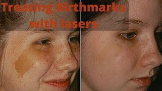 How to treat birthmarks [upl. by Lauter]