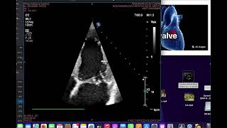 Flail anterior mitral leaflet [upl. by Takashi]