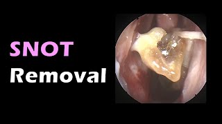 BIG nose snot removal [upl. by Medina]