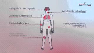 Symptome bei Lymphomerkrankungen [upl. by Heringer9]