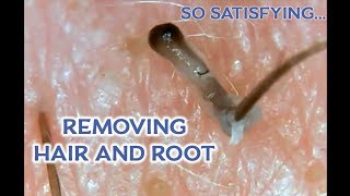 Squishys 2 Ingrown Hair Root Removal Microscopic [upl. by Lianna]