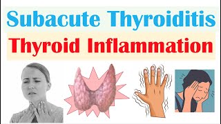 Subacute Thyroiditis Thyroid Inflammation De Quervain’s  Causes Symptoms Diagnosis Treatment [upl. by Ednalrym489]