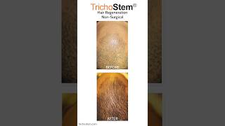 Why TrichoStem Hair Regeneration Patients can Stop Using Minoxidil minoxidil [upl. by Paddie770]