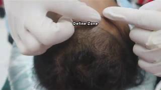 FUE HAIR TRANSPLANT IMPLANTER  Iplus Hair Regrowth Expert [upl. by Annaicul]